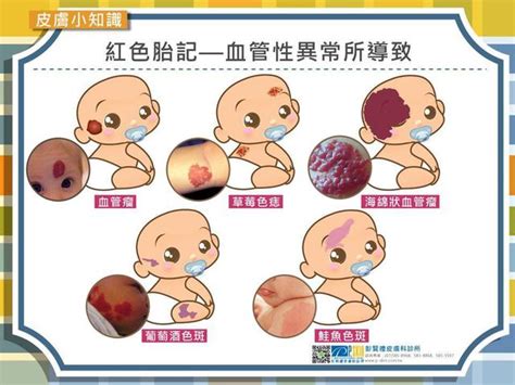 新生兒 胎記|胎記怎麼產生、何時消除？醫師剖析胎記種類、胎記寓意